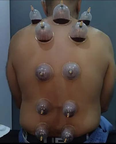Lenasia Cupping centre
