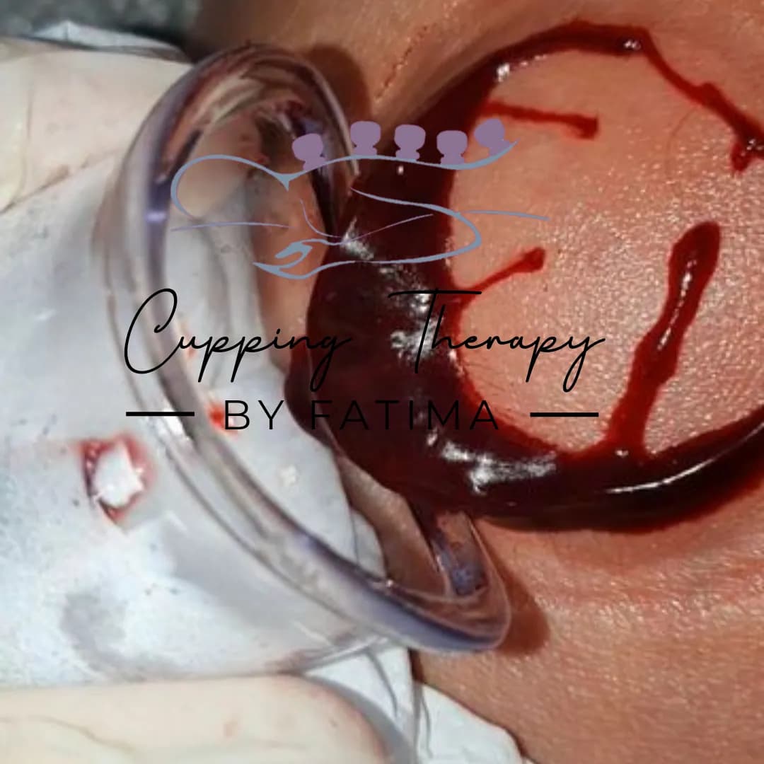 Cupping Therapy by Fatima